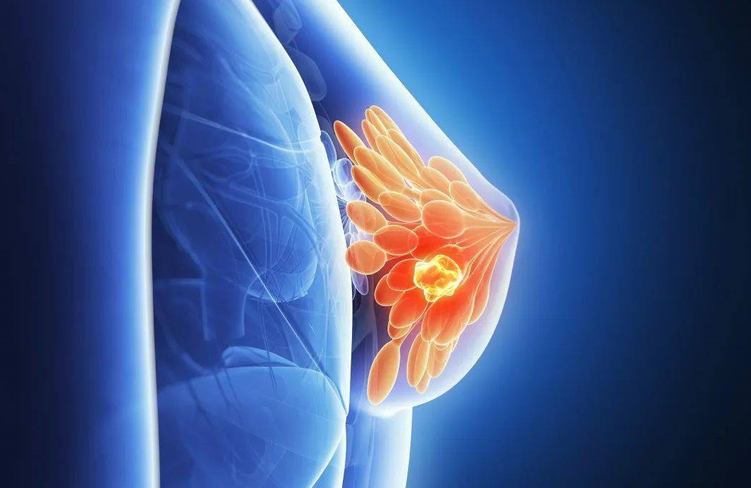 乳腺肿瘤可以治愈吗 乳腺肿瘤治愈率高吗