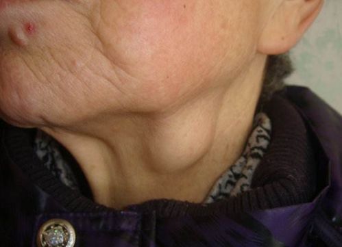 江苏省肿瘤护理工资多少 江苏省肿瘤护理工资多少