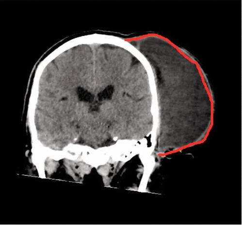 性生活会有什么肿瘤影响 性生活会有什么肿瘤影响