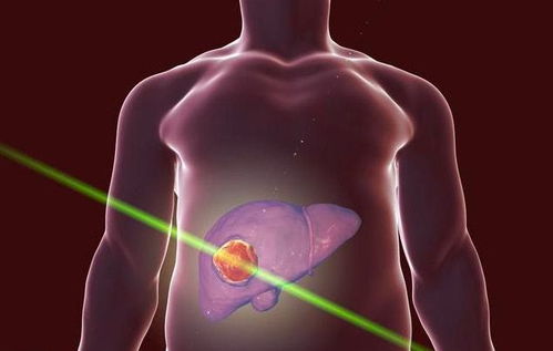 软骨类肿瘤影像表现为 软骨类肿瘤影像表现为