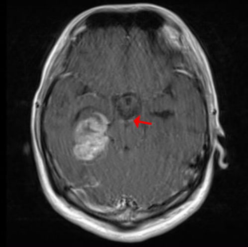 如果肿瘤缩小了怎么知道 如果肿瘤缩小了怎么知道