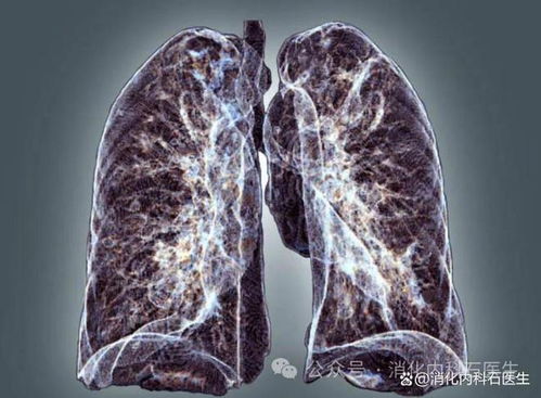 脑内肿瘤化验不出来结果 脑内肿瘤化验不出来结果