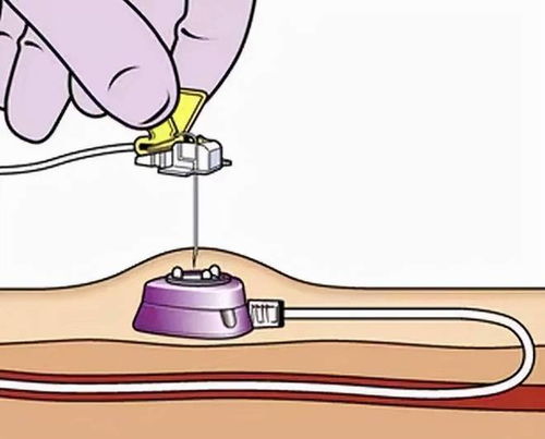 眼眶肿瘤手术必须全麻吗 眼眶肿瘤手术必须全麻吗