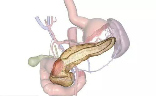 什么是原发性胸椎肿瘤 什么是原发性胸椎肿瘤