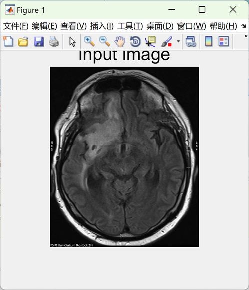 肾脏肿瘤手术要多久恢复 肾脏肿瘤手术要多久恢复