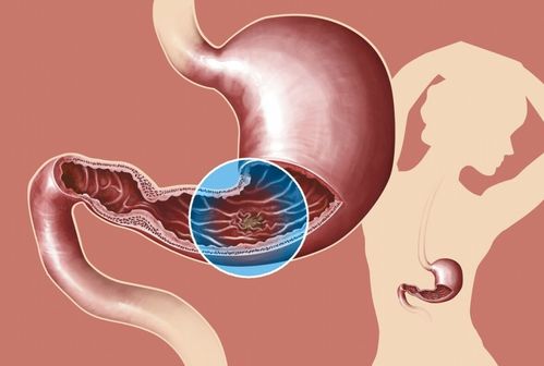 精原细胞肿瘤诊疗指南 精原细胞肿瘤诊疗指南