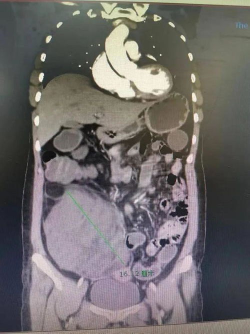 颈部淋巴结肿瘤会爆吗 颈部淋巴结肿瘤会爆吗