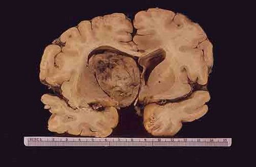 肿瘤前期可以治疗吗 肿瘤前期能查出来吗 肿瘤前期可以治疗吗 肿瘤前期能查出来吗