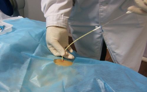 丘脑肿瘤会引起脸肿吗 丘脑肿瘤会引起脸肿吗