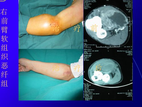 胃肿瘤切除手术要住院吗 胃肿瘤切除手术要住院吗