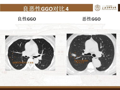 枣庄四院肿瘤科医生 枣庄第四医院 枣庄四院肿瘤科医生 枣庄第四医院