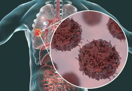 腮腺良性肿瘤手术费用 腮腺良性肿瘤手术费用