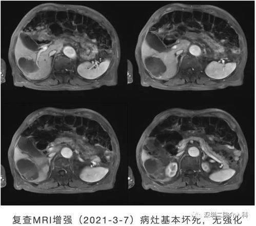 湘雅医院肿瘤张鹏飞(湘雅医院黄鹏) 湘雅医院肿瘤张鹏飞(湘雅医院黄鹏)