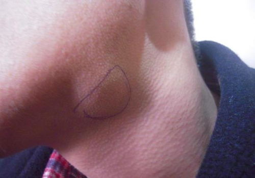 鼻肿瘤怎么治疗好的最快 鼻肿瘤怎么治疗好的最快