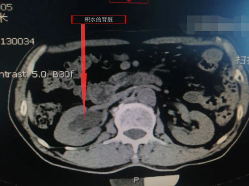 肺上有个小肿瘤怎么治好 肺上有个小肿瘤怎么治好