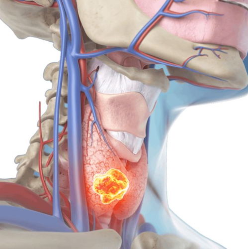 脑软骨肉瘤是恶性肿瘤嘛 脑软骨肉瘤是恶性肿瘤嘛