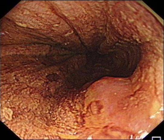 肾恶性肿瘤可以喝绿茶吗 肾恶性肿瘤可以喝绿茶吗