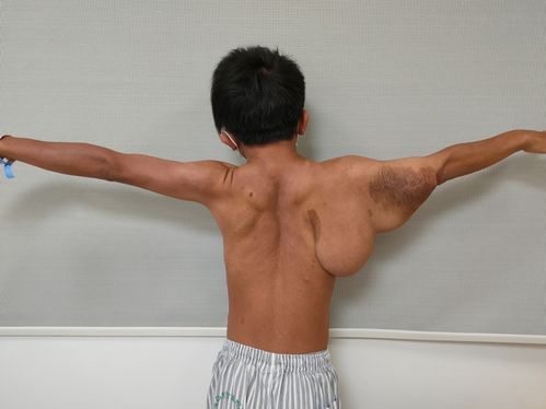 脑内肿瘤术后健康检测表 脑内肿瘤术后健康检测表