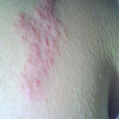 害怕骨肿瘤假体置换害怕 害怕骨肿瘤假体置换害怕