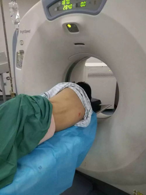 肺上肿瘤能不能做手术 肺上肿瘤能不能做手术