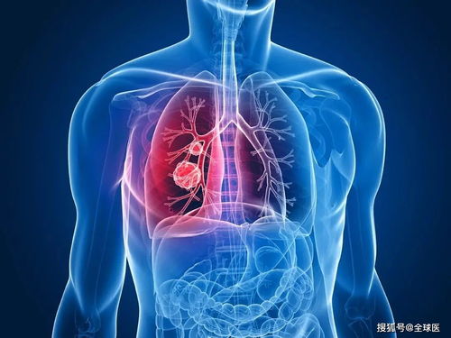 液体型肿瘤 液体瘤是怎么形成的 液体型肿瘤 液体瘤是怎么形成的