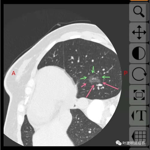 腮腺良性肿瘤治疗方法 腮腺良性肿瘤治疗方法