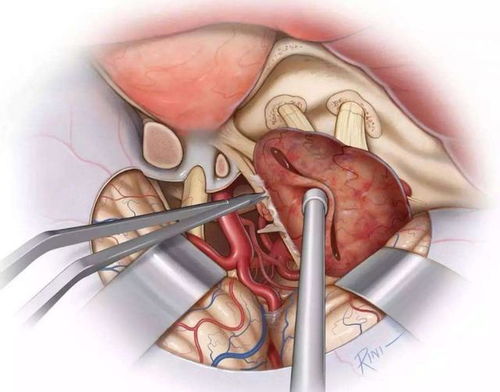 良性肿瘤该不该切除卵巢 良性肿瘤该不该切除卵巢