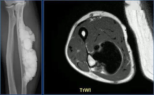胸脯疼会是肺部肿瘤么 胸脯疼会是肺部肿瘤么