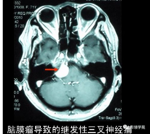 肺部肿瘤3cm什么期 肺部肿瘤3 4cm是早期还是晚期 肺部肿瘤3cm什么期 肺部肿瘤3 4cm是早期还是晚期