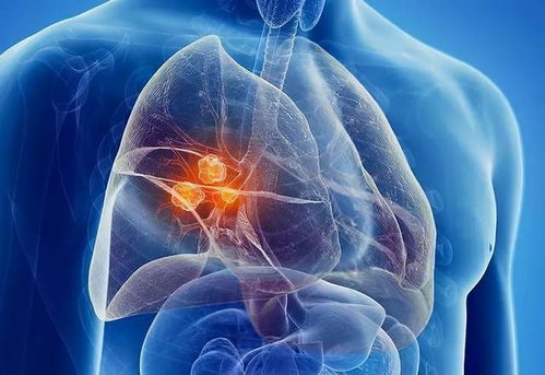 肿瘤定向靶位免 肿瘤定向靶位免费治疗吗 肿瘤定向靶位免 肿瘤定向靶位免费治疗吗