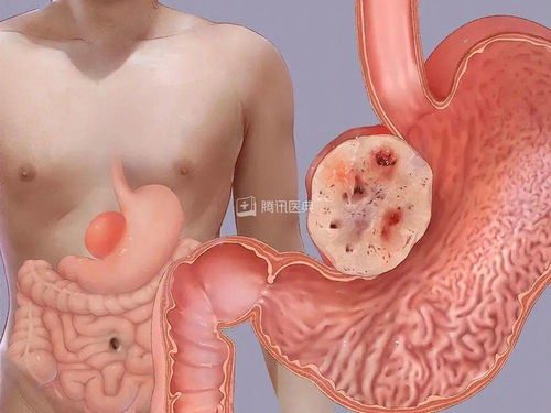 膀胱肿瘤哪一项是对的呢 膀胱肿瘤哪一项是对的呢