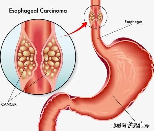 淋巴肿瘤早期能活多久 淋巴肿瘤早期能活多久