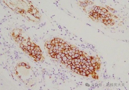 认识肿瘤预防肿瘤教案 认识肿瘤预防肿瘤教案