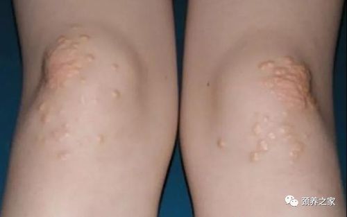 右肾肿瘤多大可以保肾 右肾肿瘤多大可以保肾