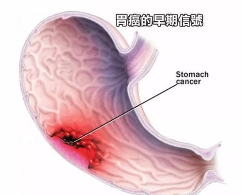 卵巢恶性肿瘤影响表现吗 卵巢恶性肿瘤影响表现吗