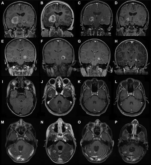 进展期胃癌肿瘤生长速度 进展期胃癌肿瘤生长速度