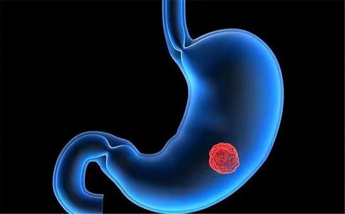 专治淋巴肿瘤的中医药材 专治淋巴肿瘤的中医药材