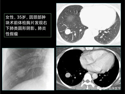 肺部淋巴肿瘤恶性肿瘤 肺部淋巴肿瘤恶性肿瘤