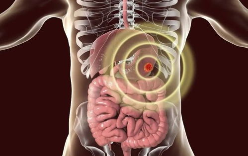 肺肿瘤引起肺积液严重吗 肺肿瘤引起肺积液严重吗
