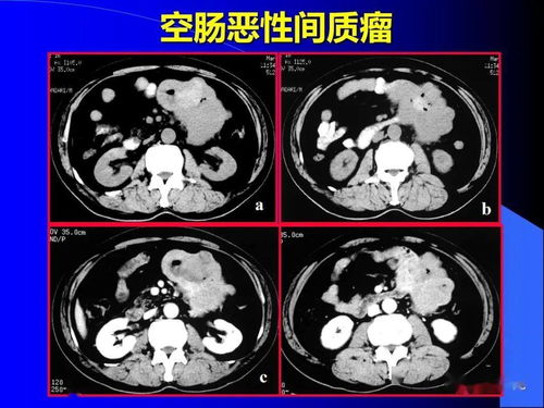 骨肿瘤的常见疾病有哪些 骨肿瘤的常见疾病有哪些