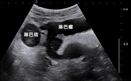 牙龈肿瘤能用阿莫西林吗 牙龈肿瘤能用阿莫西林吗