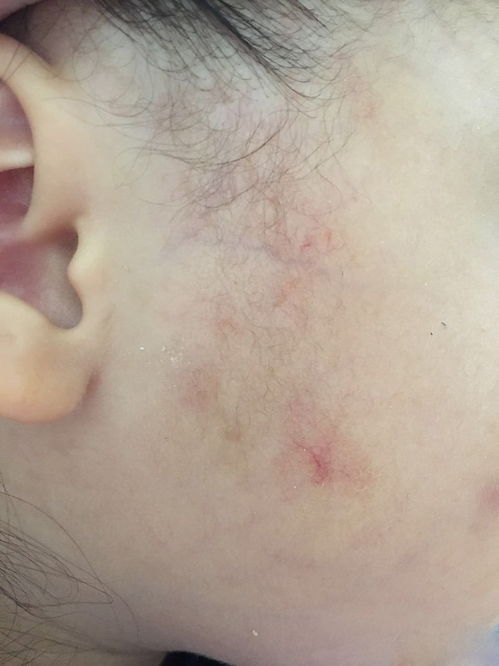 切除肾肿瘤后需要进补吗 切除肾肿瘤后需要进补吗