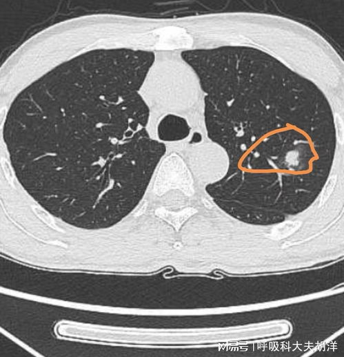 膀胱肿瘤能不能喝豆浆粉 膀胱肿瘤能不能喝豆浆粉