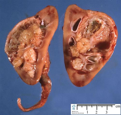 升结肠肝曲肠梗阻肿瘤 升结肠肝曲肠梗阻肿瘤