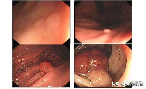 肿瘤病人能用按摩机吗 肿瘤病人能用按摩机吗