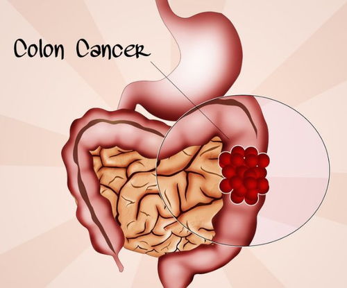 卵巢罕见肿瘤 卵巢罕见肿瘤很大是什么瘤 卵巢罕见肿瘤 卵巢罕见肿瘤很大是什么瘤