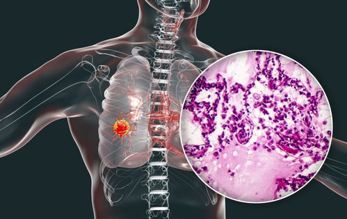 王奇峰四川省肿瘤医院 王奇峰四川省肿瘤医院