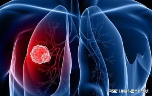 肺癌是什么性质的肿瘤 肺癌是什么性质的肿瘤