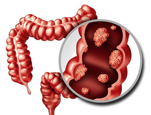 子宫肿瘤需要挂针么 子宫肿瘤需要动手术吗 子宫肿瘤需要挂针么 子宫肿瘤需要动手术吗