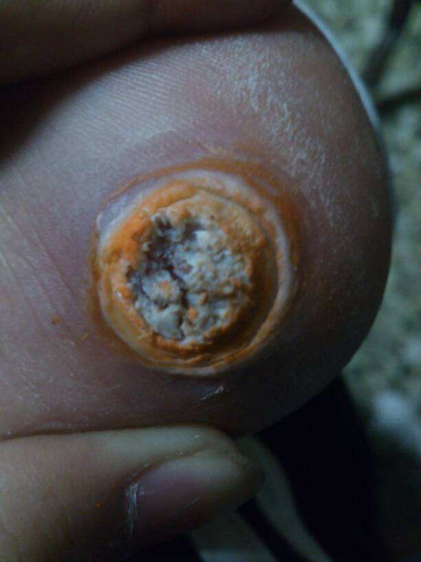 煤矿产品煤矿产品中提高胃肠道抵抗力的营养素有 煤矿产品煤矿产品中提高胃肠道抵抗力的营养素有